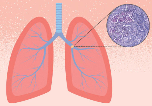 Understanding Lung Cancer - Causes, Symptoms, Treatment, and Support